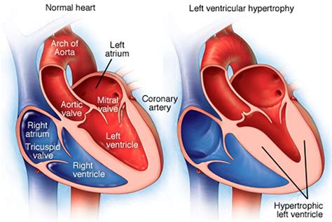 left ventricular hypertrophy images.